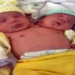 Nacen siameses con un cuerpo con dos cabezas en Brasil