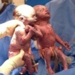 Dos gemelas en el mismo saco amniótico nacen agarradas de la mano