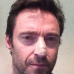 Hugh Jackman es tratado por segunda vez de un carcinoma en la nariz