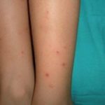 OPS alerta de la vulnerabilidad de América al virus Chikungunya; en RD rondan 40,000 infectados