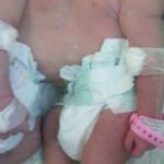 Nacen siamesas unidas por el abdomen en el hospital Cabral y Báez