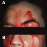 Una joven italiana suda sangre por cara y manos